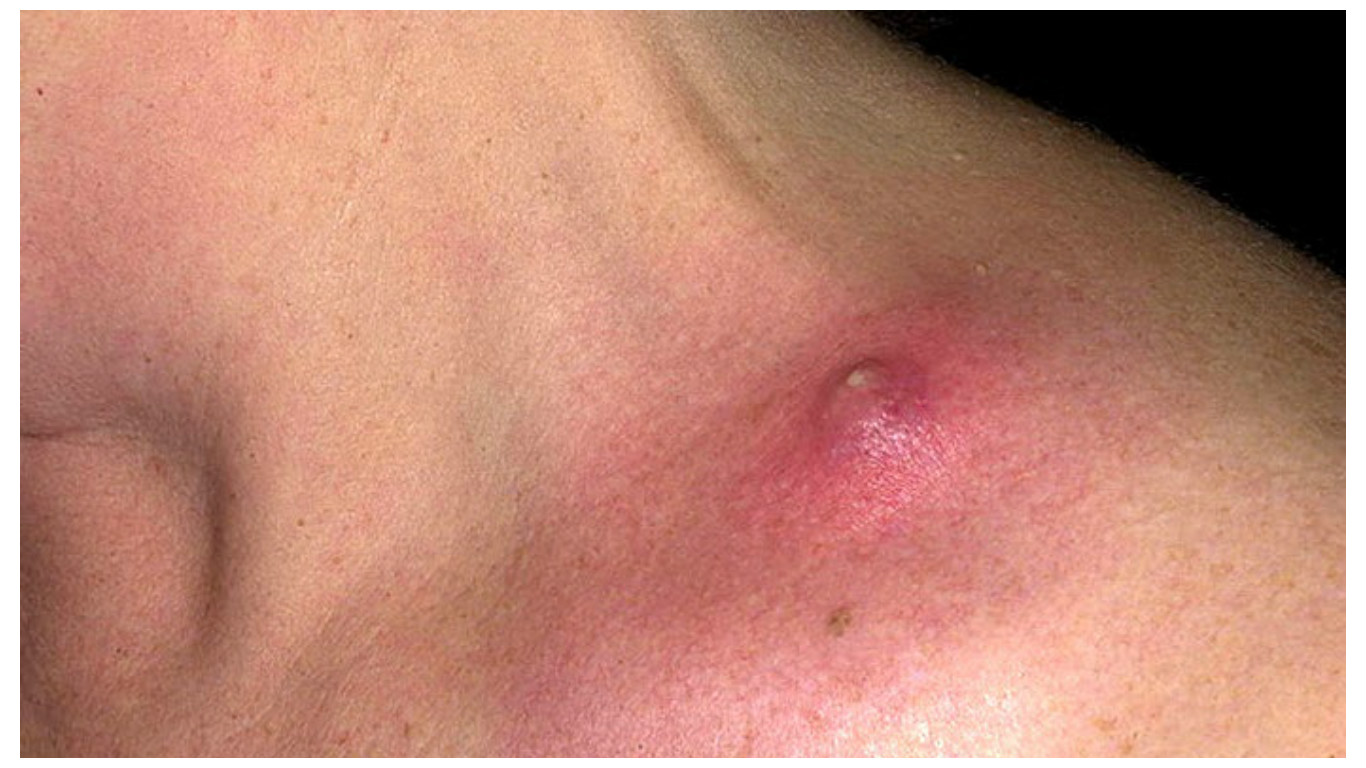 фурункул на груди у женщин лечение фото 12