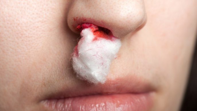 Как остановить кровь из носа у взрослого в домашних условиях и тошнит