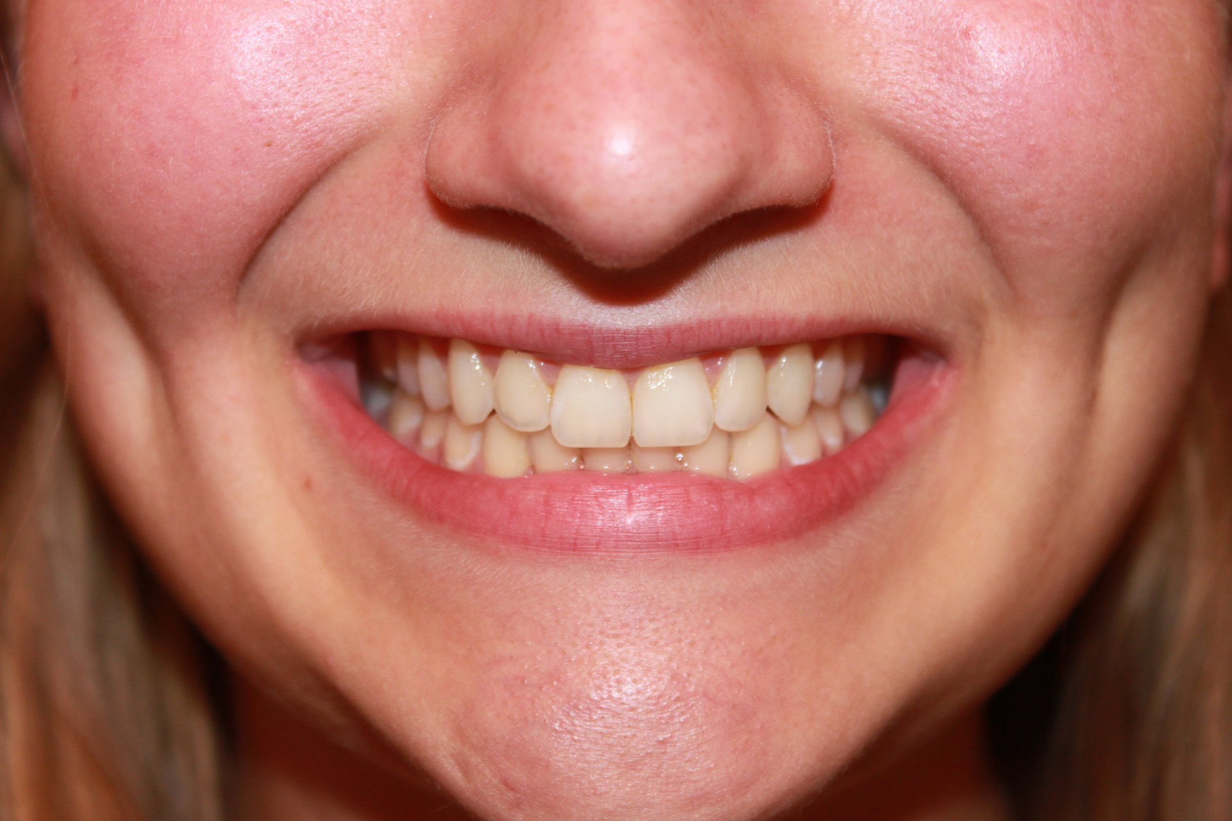 фото нижних зубов