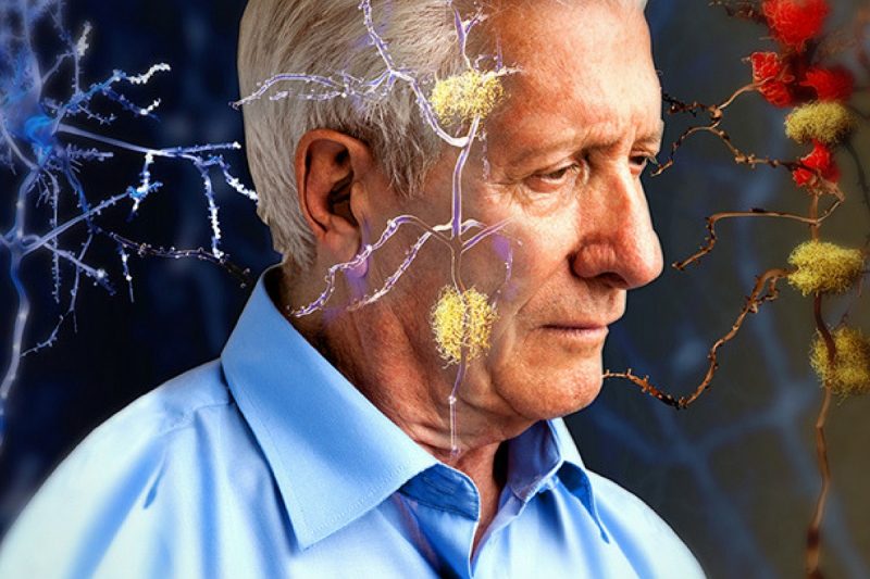 Причины возникновения болезни Альцгеймера