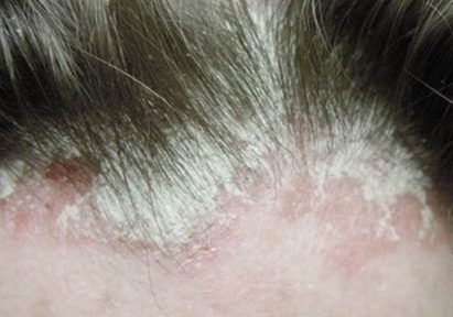 Псориаз на лице: как лечить, причины и симптомы заболевания