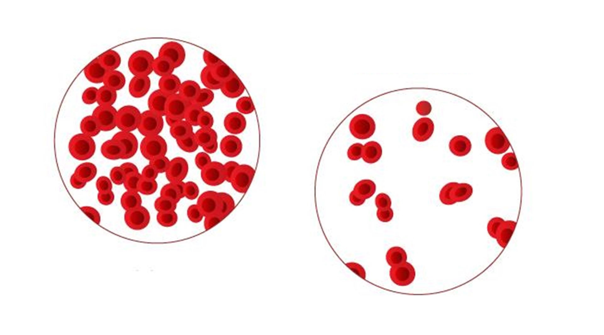 Анемия 18. Гемоглобин классификация анемии. Эритроциты в крови анемия. Железодефицитная анемия картина крови.